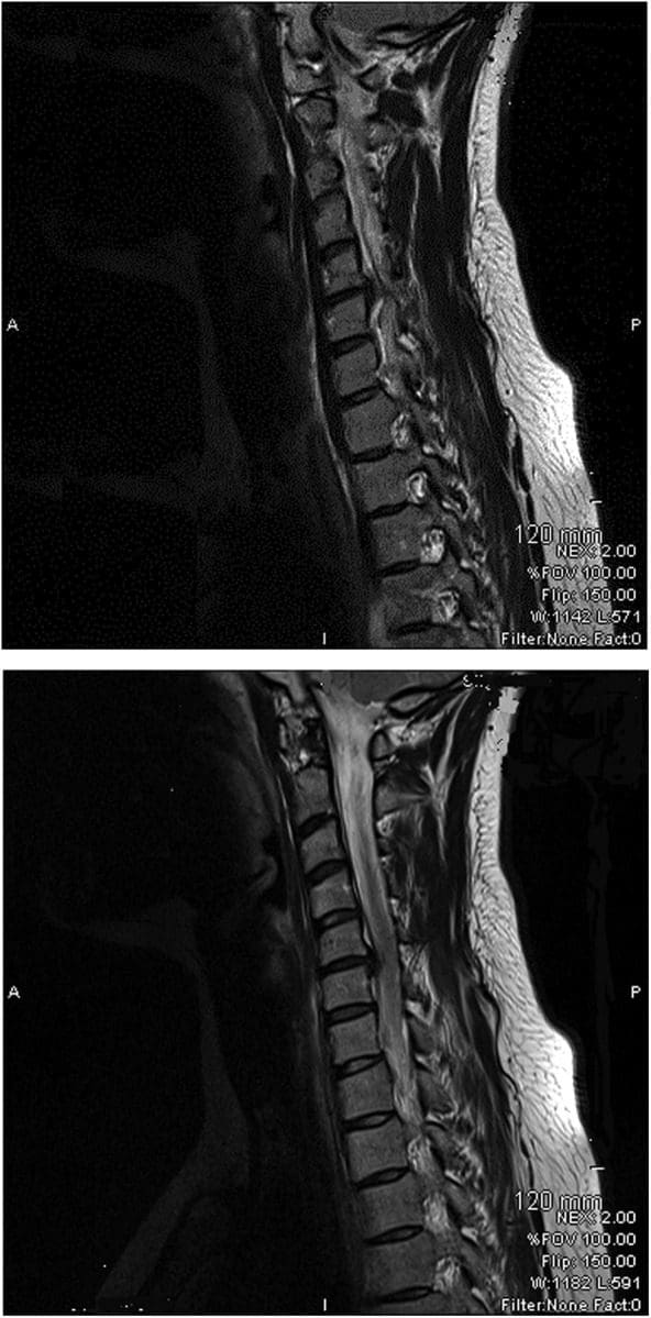 Figura 1 Loss of Lordosis cervicale della colonna vertebrale e ernia del disco grande a C5 e C6 sulla risonanza magnetica