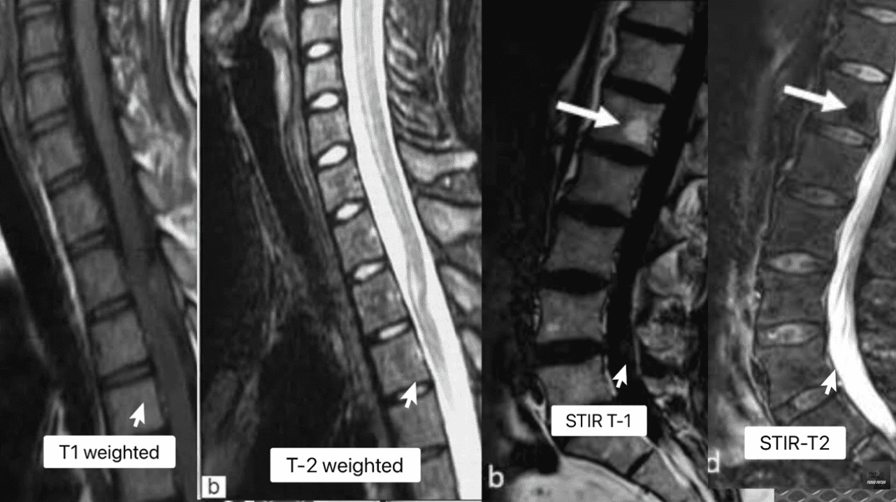 Staging Injury: T1 vs T2 vs T2 Fat Saturation & STIR Deliniation