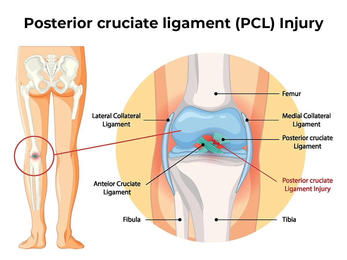 Dashboard Knee Injuries in Car Accidents and Recovery